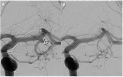 Frontiers | Flow Diversion for the Treatment of MCA Bifurcation ...