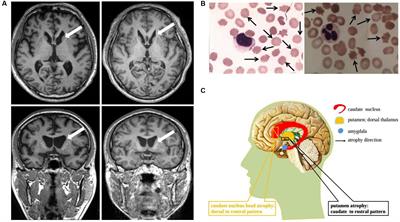 Frontiers | Novel VPS13A Gene Mutations Identified in Patients ...