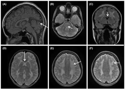 Frontiers Mitochondrial Neurogastrointestinal Encephalomyopathy Caused By Thymidine Phosphorylase Enzyme Deficiency From Pathogenesis To Emerging Therapeutic Options Cellular Neuroscience