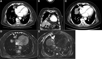 Frontiers | A Case of Pulmonary Carcinoid Tumor with a Superimposed ...