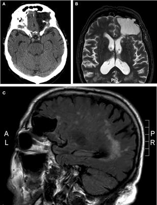 Frontiers | Pulsatile Proptosis due to Intraorbital Meningocele