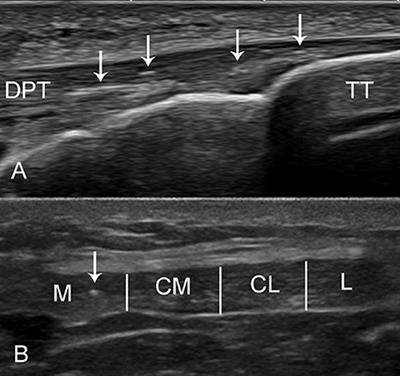 Frontiers | Intratendinous Air Phenomenon: A New Ultrasound Marker of ...