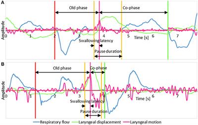 Frontiers | Inappropriate Timing of Swallow in the Respiratory Cycle ...