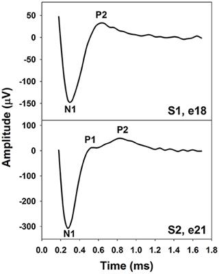 Otolaryngology: Open Access - Mapping Auditory Maturation from Neonates to  Toddlers using Electrophysiological Responses of the Brainstem