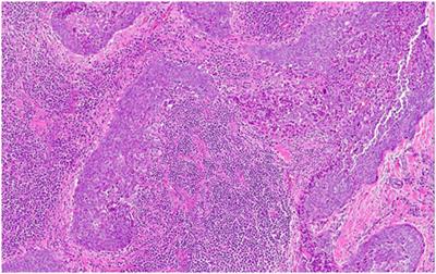 Frontiers | CASTLE Thyroid Tumor: A Case Report and Literature Review