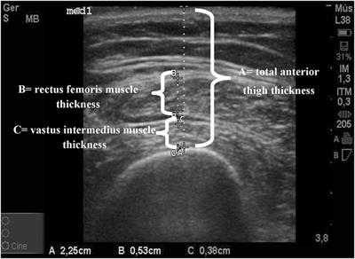 Frontiers | Bedside Ultrasound of Quadriceps to Predict ...