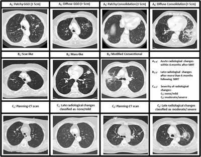 Frontiers | Parenchymal and Functional Lung Changes after Stereotactic ...