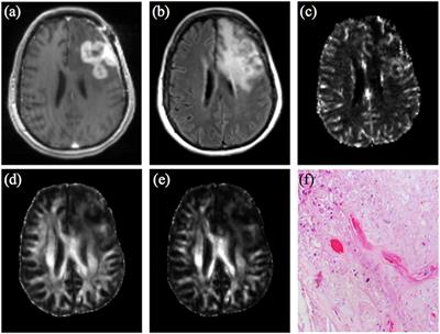 Frontiers | Commentary: Pitfalls in the Neuroimaging of Glioblastoma in ...