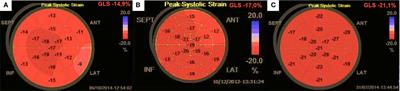 Frontiers | Cushing’s Disease: Subclinical Left Ventricular Systolic ...