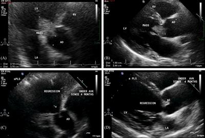 Frontiers | Complete Resolution of a Large Bicuspid Aortic Valve ...