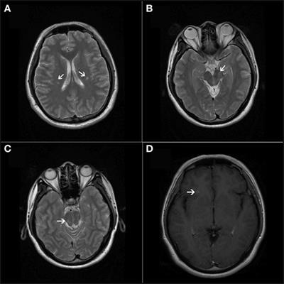 Frontiers | Paroxysmal Symptoms As the First Manifestation of Multiple ...