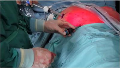 Frontiers  Case Report: 21 Cases of Umbilical Hernia Repair Using a  Laparoscopic Cephalic Approach Plus a Posterior Sheath and Extraperitoneal  Approach