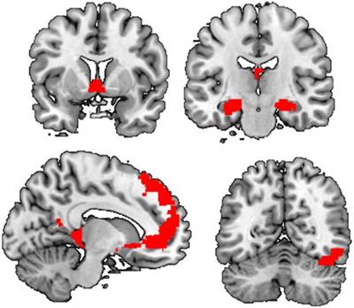 Frontiers | Enhanced Amygdala-Striatal Functional Connectivity during ...