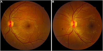 Frontiers | Non-Mydriatic Fundus Retinography in Screening for Diabetic ...