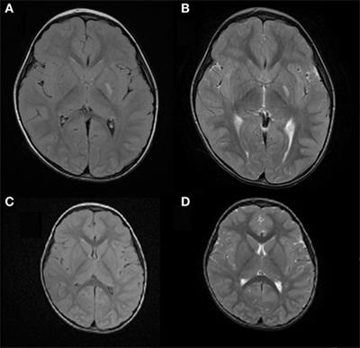 Frontiers | Acute Hemichorea Can Be the Only Clinical Manifestation of ...