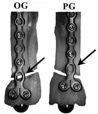 Screw visual observation showed the fractured screws (upper), some