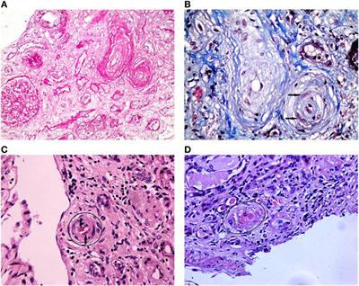 Frontiers | Antiphospholipid Syndrome Nephropathy: From Pathogenesis to ...