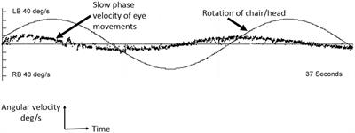 Frontiers Bilateral Vestibular Dysfunction Associated With