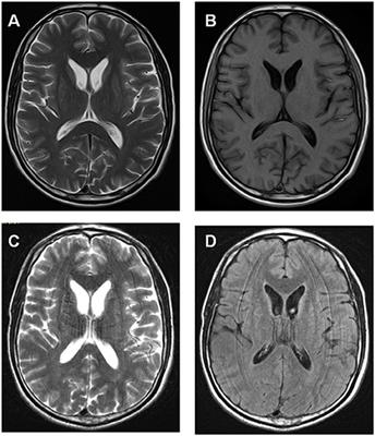 Frontiers | Chorea-Acanthocytosis in a Chinese Family With a Pseudo ...