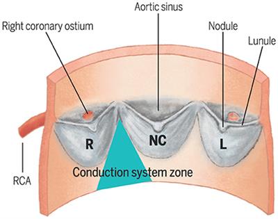 Speckle tracking strain and ECG heterogeneity correlate in transcatheter  aortic valve replacement-induced left bundle branch blocks and right  ventricular paced rhythms