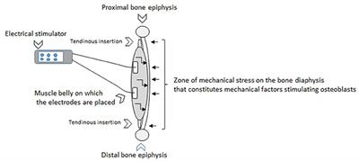 Bone Stimulators & How to Return to Running After a Stress