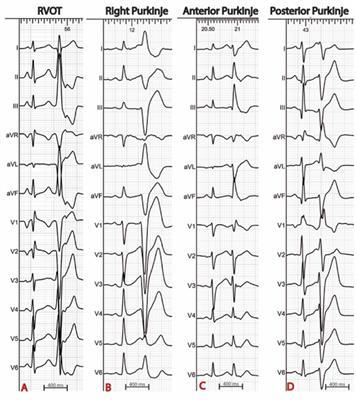 Frontiers | Mapping and Ablation of Idiopathic Ventricular Fibrillation