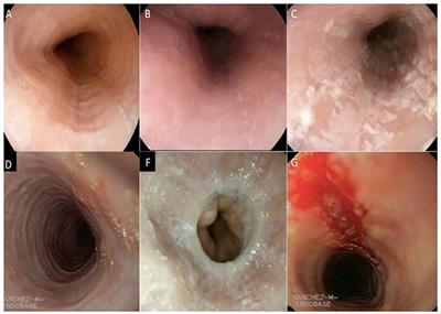 Frontiers Eosinophilic Esophagitis Review And Update Medicine