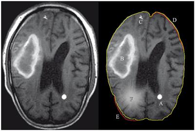 Frontiers | Survey of Image Processing Techniques for Brain Pathology ...