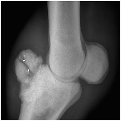 Frontiers Osteochondroma Of The First Phalanx In Tbourida - 