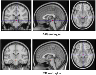 Frontiers Resting State Functional Connectivity Of Dorsal Raphe Nucleus And Ventral Tegmental Area In Medication Free Young Adults With Major Depression Psychiatry