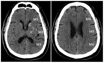 Frontiers | A Simple Imaging Guide for Endovascular Thrombectomy in ...