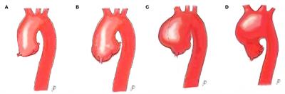 Frontiers | Evolving Surgical Approaches to Bicuspid Aortic Valve ...