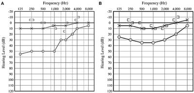 Frontiers | Vestibule-Middle Ear Dehiscence Tested With Perilymph ...