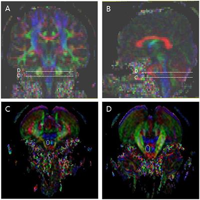 Frontiers | Corticospinal Tract Integrity and Long-Term Hand Function ...