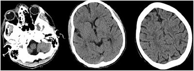 Frontiers | Diagnosis of Rhinocerebral Mucormycosis by ...