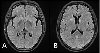 Frontiers | Immune Reconstitution Inflammatory Syndrome Secondary to ...