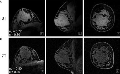 Imaging in Breast Cancer