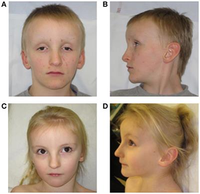 Frontiers | Deletion of chr7p22 and chr15q11: Two Familial Cases of ...