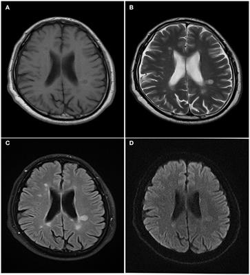 Frontiers | Progressive Multifocal Leukoencephalopathy Diagnosed by ...