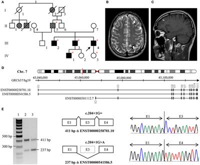 Novel Pathogenic Variants In A Cassette Exon Of Ccm2 In Patients With Cerebral Cavernous Malformations Neurology Frontiers
