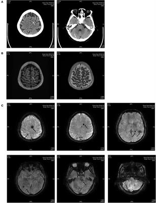 Frontiers | A Novel CCM2 Gene Mutation Associated With Cerebral ...