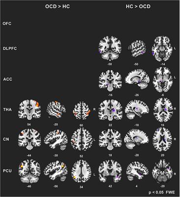Frontiers Functional Connectivity Changes In Obsessive Compulsive Disorder Correspond To Interference Control And Obsessions Severity Neurology