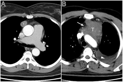 Frontiers | Relationship Between Computed Tomography Imaging Features ...