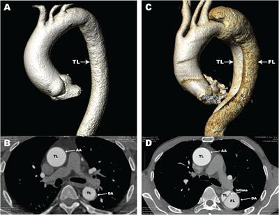 Frontiers | The Role of Macrophages in Aortic Dissection