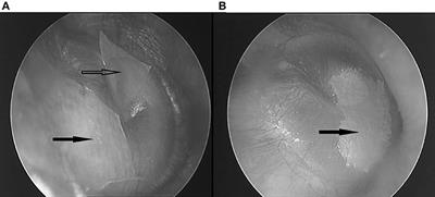 Frontiers | Tympanic Resonance Hypothesis