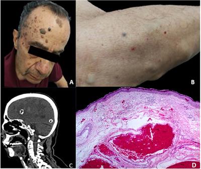 Frontiers | Blue Rubber Bleb Nevus Syndrome With Multiple Cavernoma ...