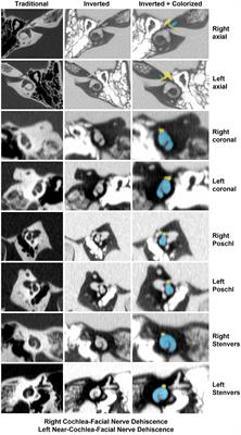 Frontiers  Audiovestibular Quantification in Rare Third Window