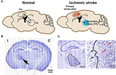 Effects of Stroke - Milka Clarke Stroke Brain Trauma Foundation