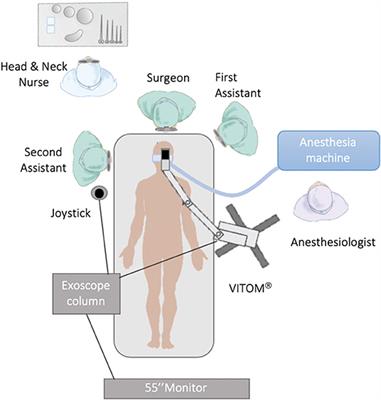 Frontiers | 3D Exoscopic Surgery (3Des) for Transoral Oropharyngectomy