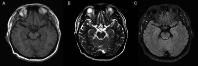 Frontiers | Hashimoto’s Encephalopathy Mimicking Viral Encephalitis: A ...